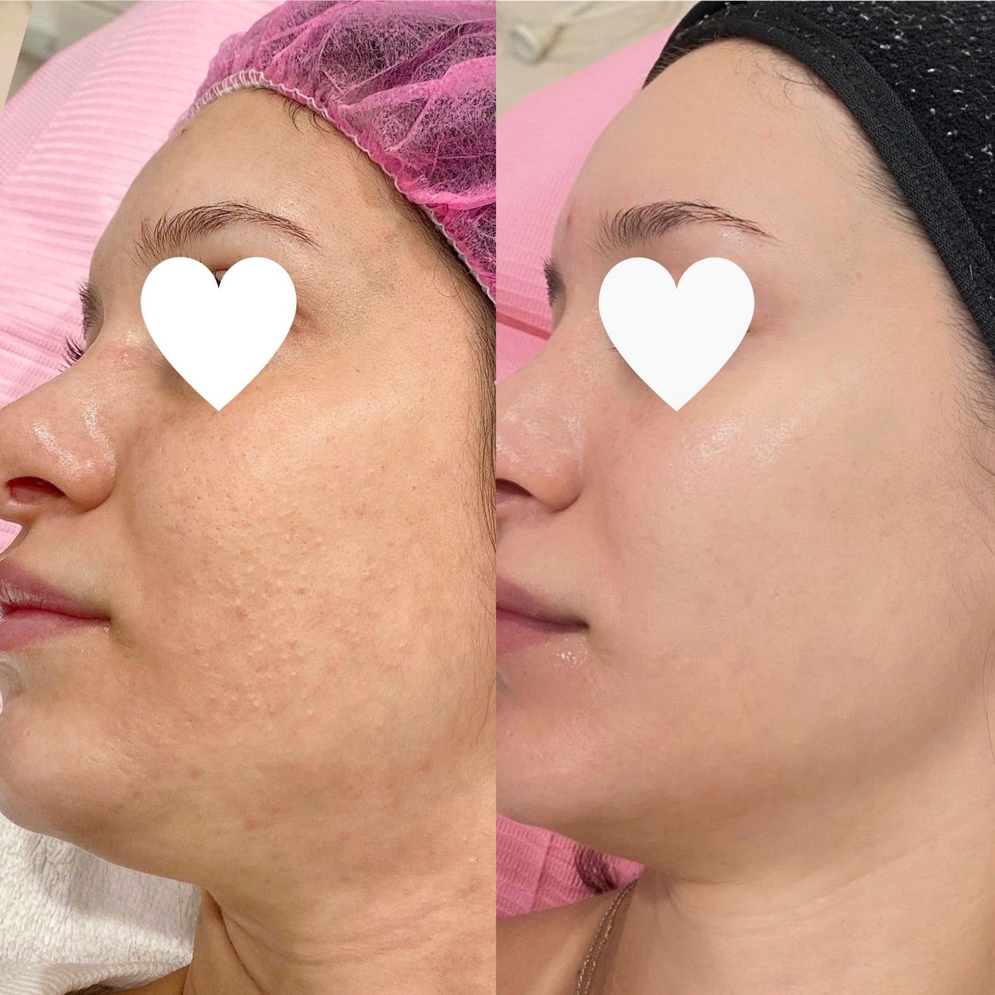 Smooth and Clarity Protocol: Baby Sizes