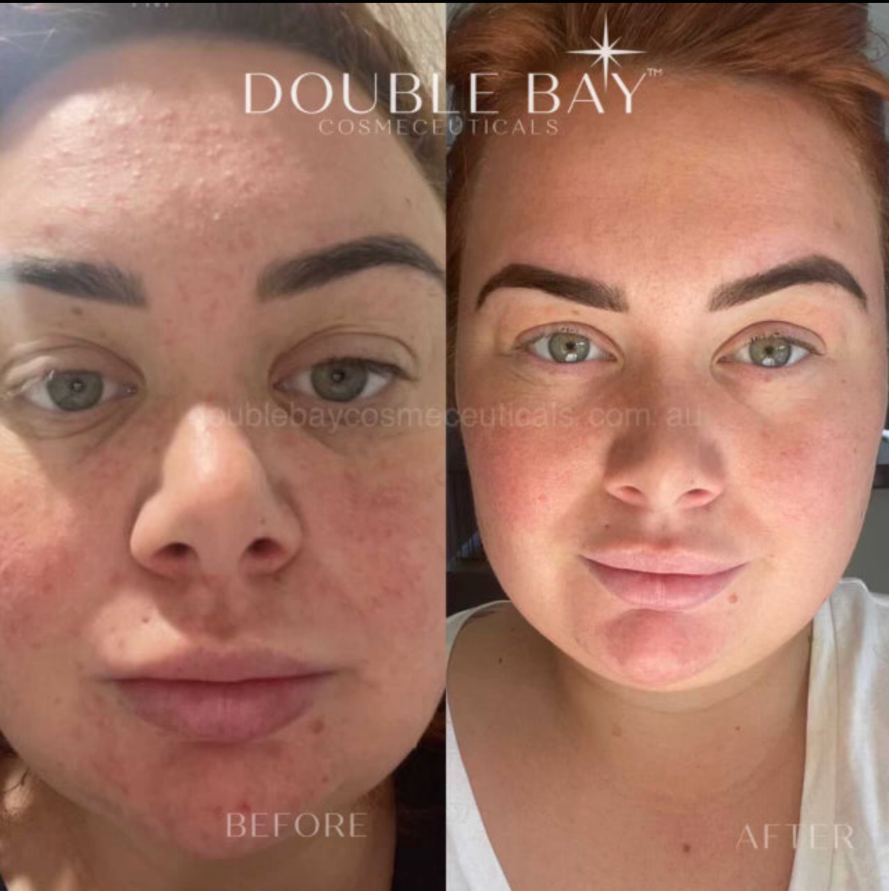 Phaseolus Radiatus 3% + Squalane 2% 20min-2hr Mask