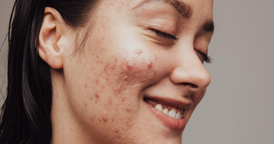 A Guide to Blemish-Prone Skincare